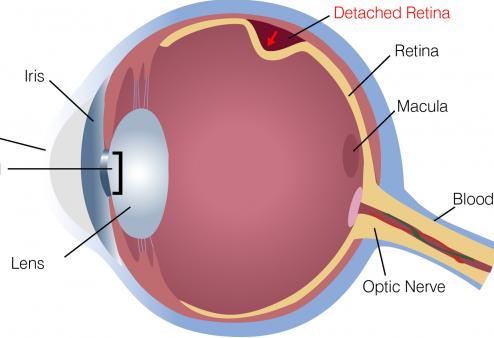 Diagram depicting detached retina